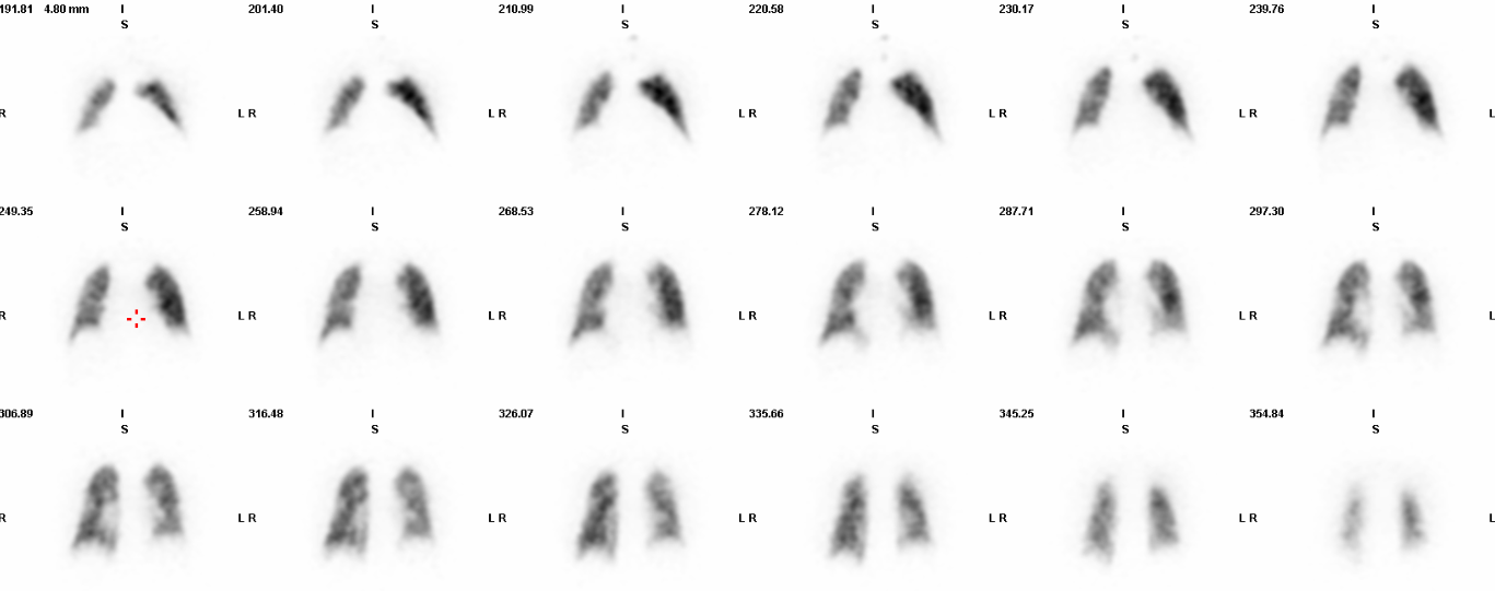 Lung scintigraphy (V/Q scan)