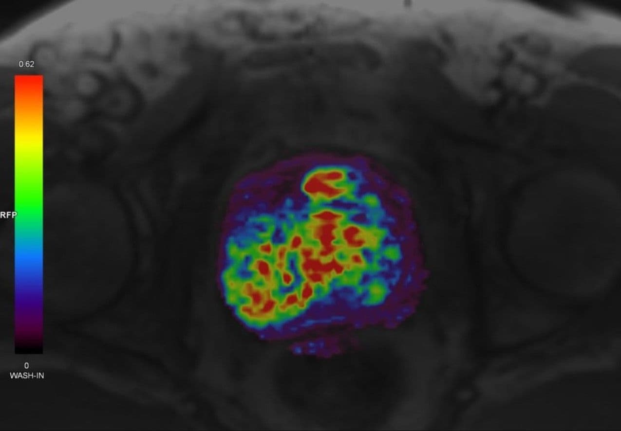 Wie funktioniert das multiparametrische Prostata-MRT? image