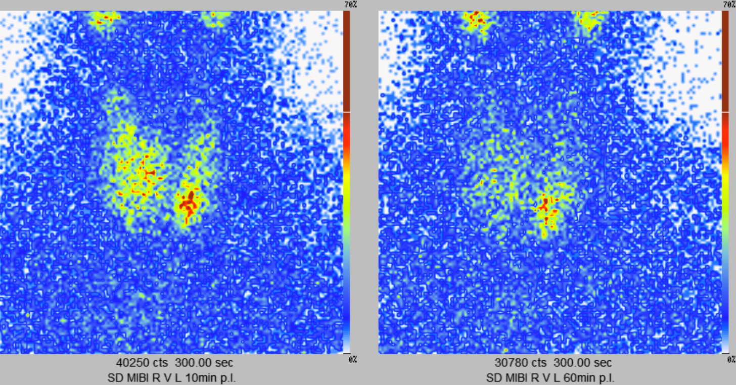 Gastric Emptying Scintigraphy