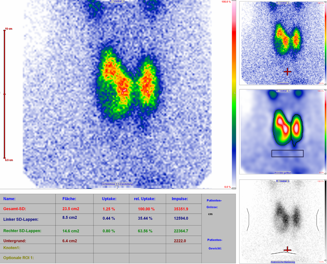 Thyroid scintigraphy (+ suppression)