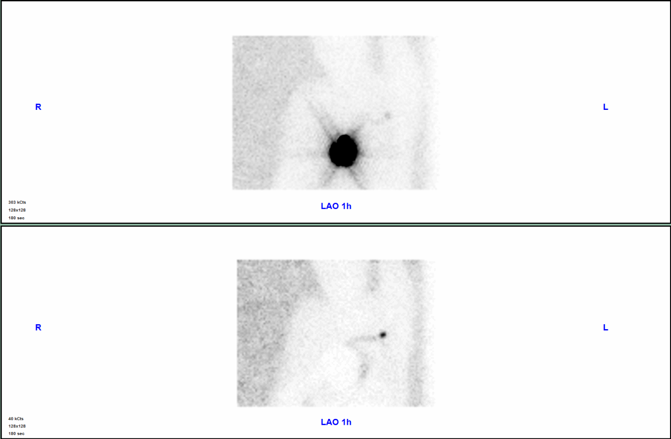 Sentinel Lymph Node Scintigraphy