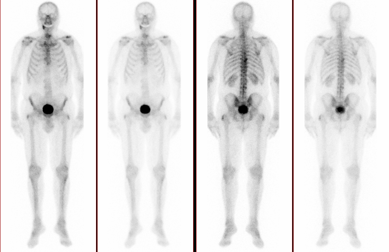 Bone Scintigraphy