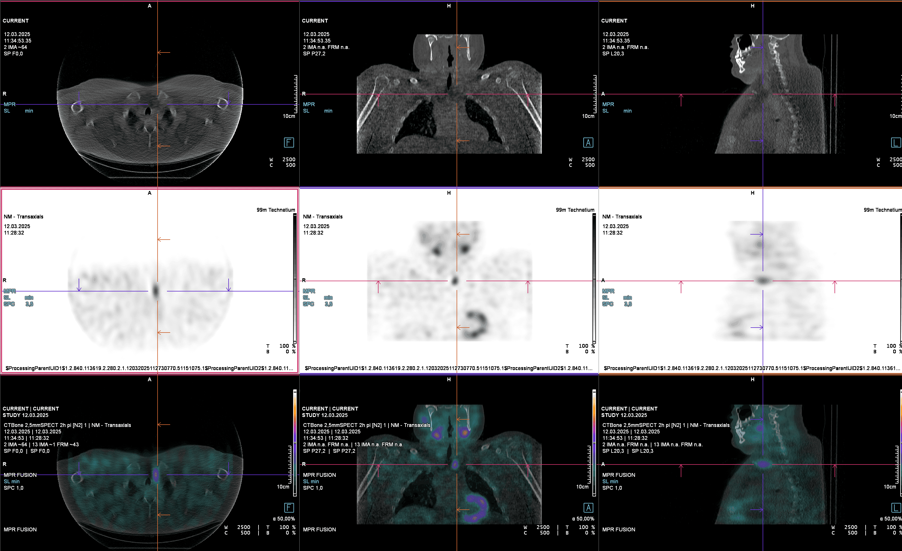 Parathyroid scintigraphy